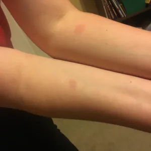 tb test bruise 1686990152