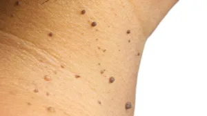 warts black skin 1687690885