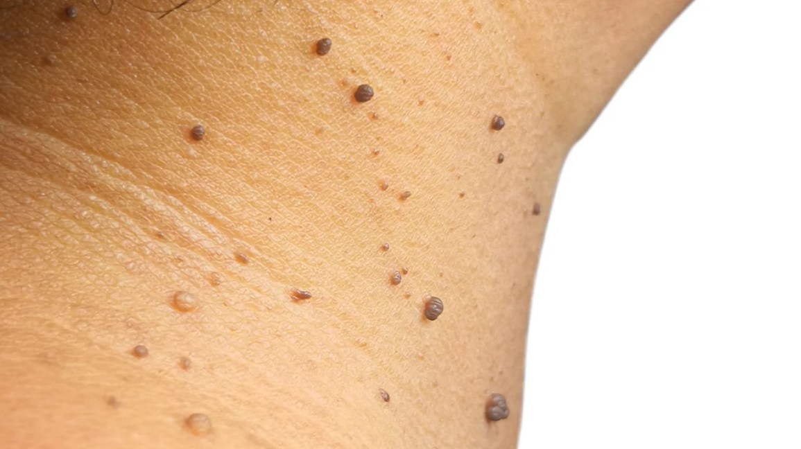 Why Warts Turn Black