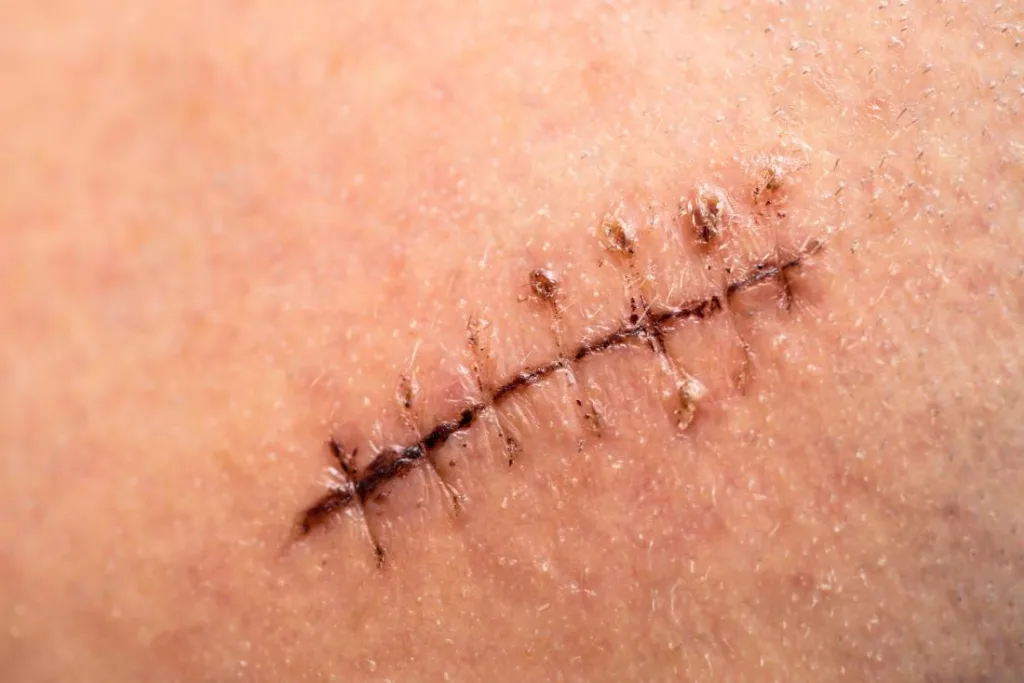 dissolvable stitches 1688817933