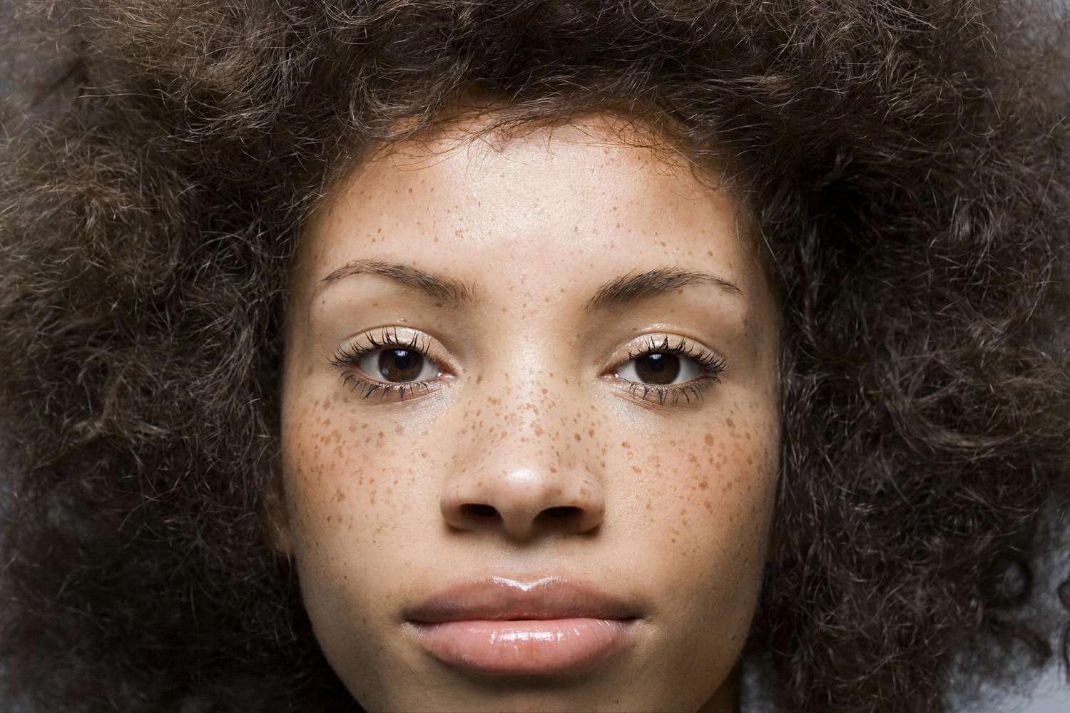 what causes freckles to suddenly appear