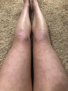 purple and blotchy legs 1694881543